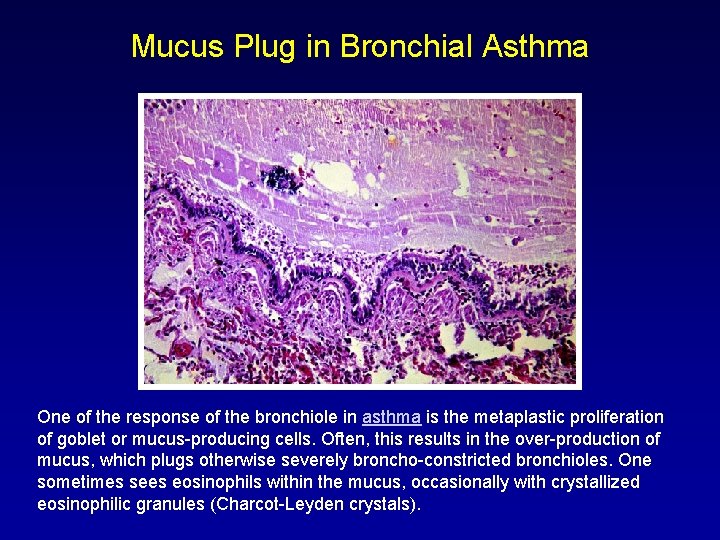 Mucus Plug in Bronchial Asthma One of the response of the bronchiole in asthma