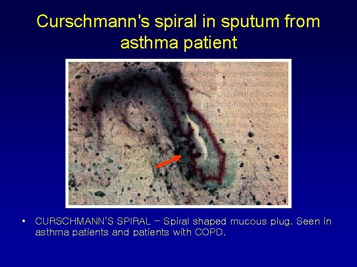 Curschmann's spiral in sputum from asthma patient • CURSCHMANN'S SPIRAL - Spiral shaped mucous