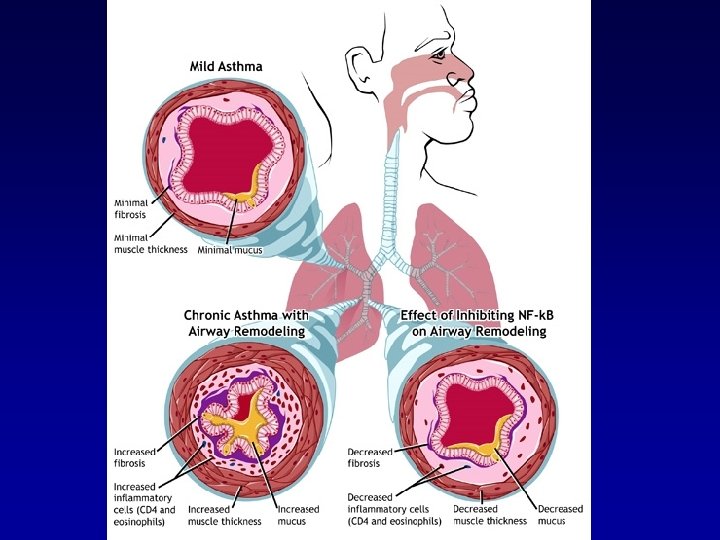 Pathophysiology Of Asthma Flowchart