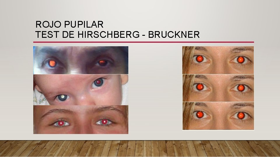 ROJO PUPILAR TEST DE HIRSCHBERG - BRUCKNER 