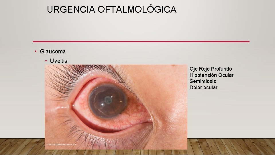 URGENCIA OFTALMOLÓGICA • Glaucoma • Uveitis Ojo Rojo Profundo Hipotensión Ocular Semimiosis Dolor ocular