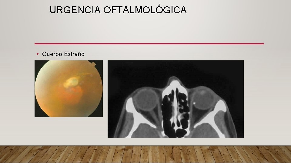URGENCIA OFTALMOLÓGICA • Cuerpo Extraño 