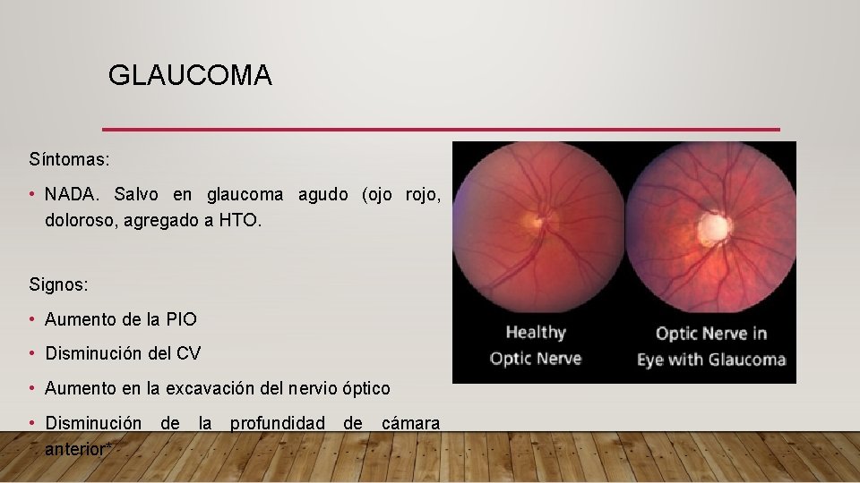 GLAUCOMA Síntomas: • NADA. Salvo en glaucoma agudo (ojo rojo, doloroso, agregado a HTO.