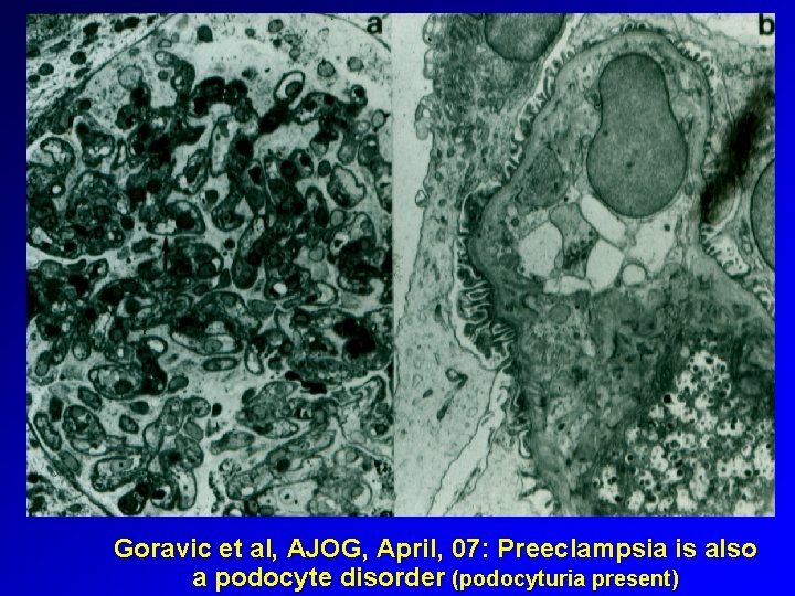 Goravic et al, AJOG, April, 07: Preeclampsia is also a podocyte disorder (podocyturia present)