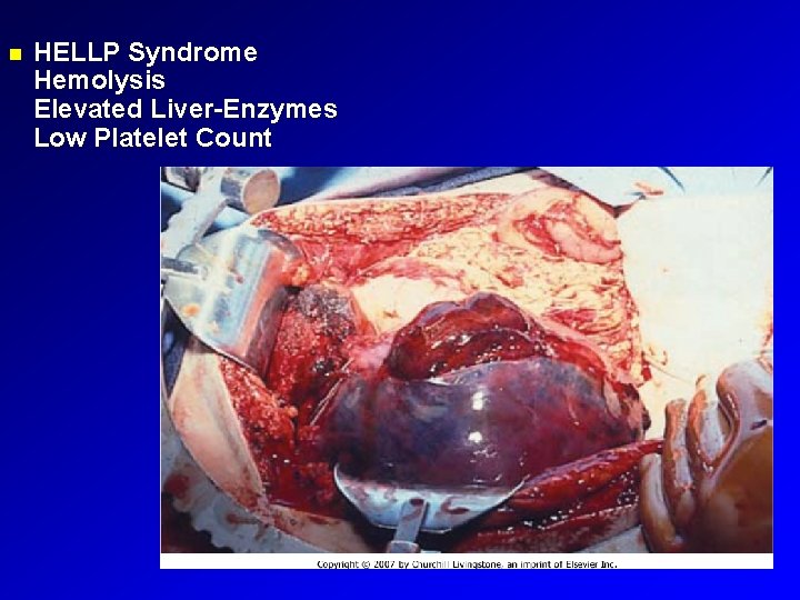  HELLP Syndrome Hemolysis Elevated Liver-Enzymes Low Platelet Count 