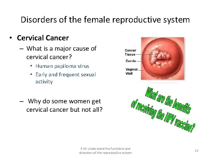 Disorders of the female reproductive system • Cervical Cancer – What is a major