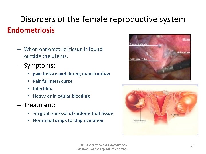 Disorders of the female reproductive system Endometriosis – When endometrial tissue is found outside