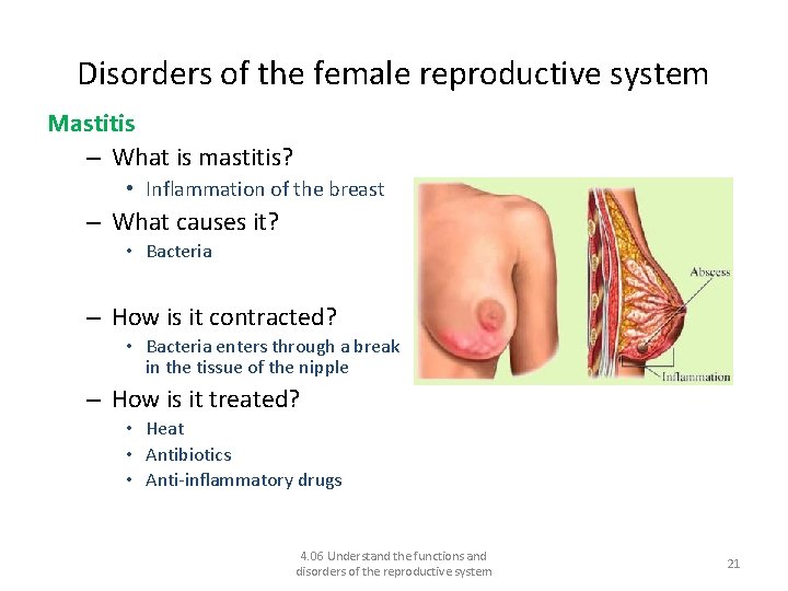 Disorders of the female reproductive system Mastitis – What is mastitis? • Inflammation of