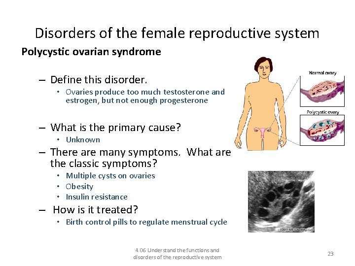 Disorders of the female reproductive system Polycystic ovarian syndrome – Define this disorder. •