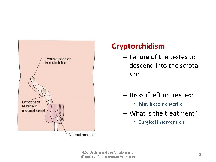 Disorders of the male reproductive system and their treatments Cryptorchidism – Failure of the