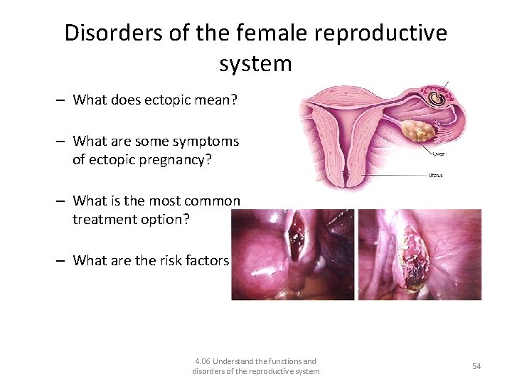 Disorders of the female reproductive system Ectopic pregnancy – What does ectopic mean? –
