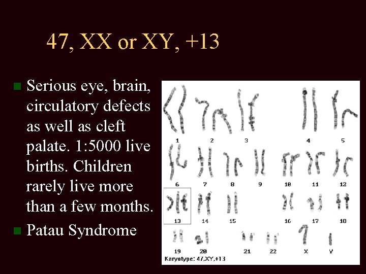 47, XX or XY, +13 Serious eye, brain, circulatory defects as well as cleft