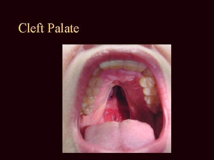 Cleft Palate 