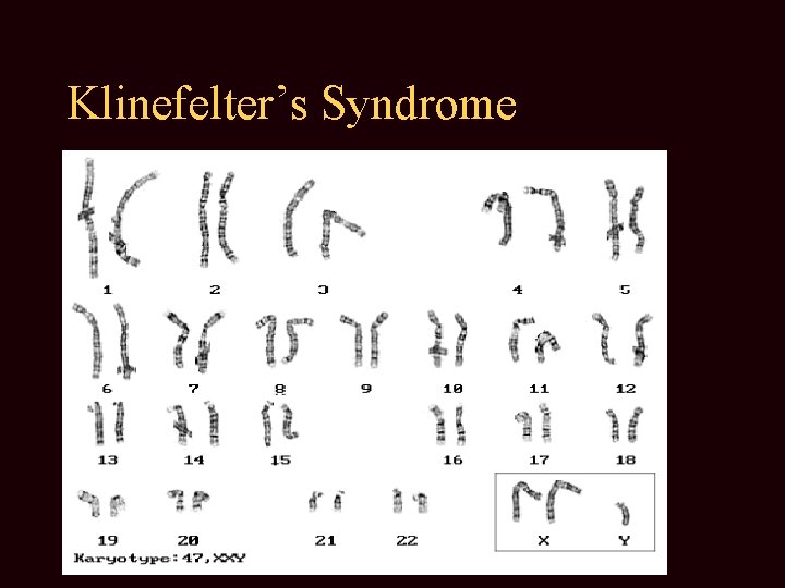 Klinefelter’s Syndrome 