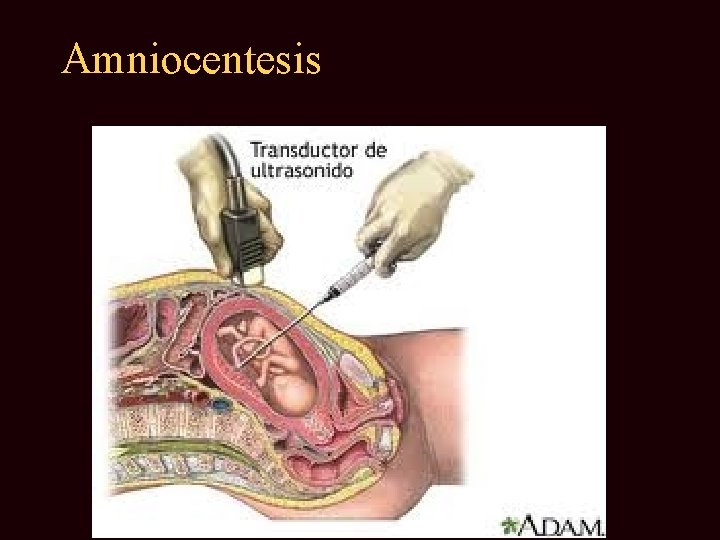 Amniocentesis 
