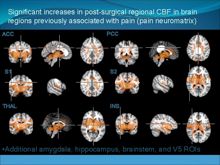 Significant increases in post-surgical regional CBF in brain regions previously associated with pain (pain