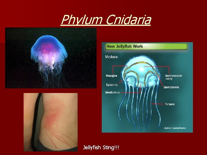 Phylum Cnidaria Jellyfish Sting!!! 