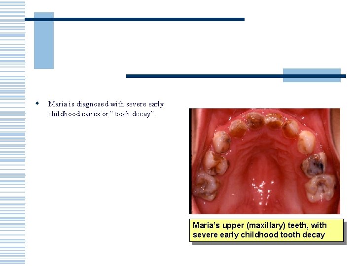 w Maria is diagnosed with severe early childhood caries or “tooth decay”. Maria’s upper