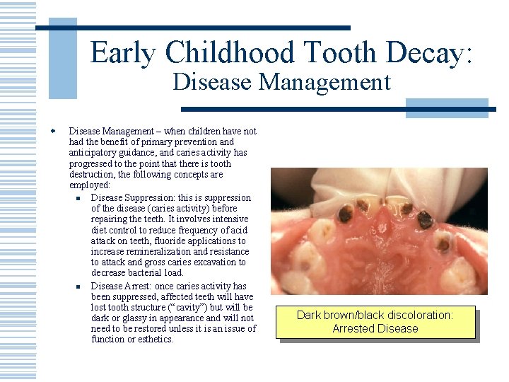 Early Childhood Tooth Decay: Disease Management w Disease Management – when children have not