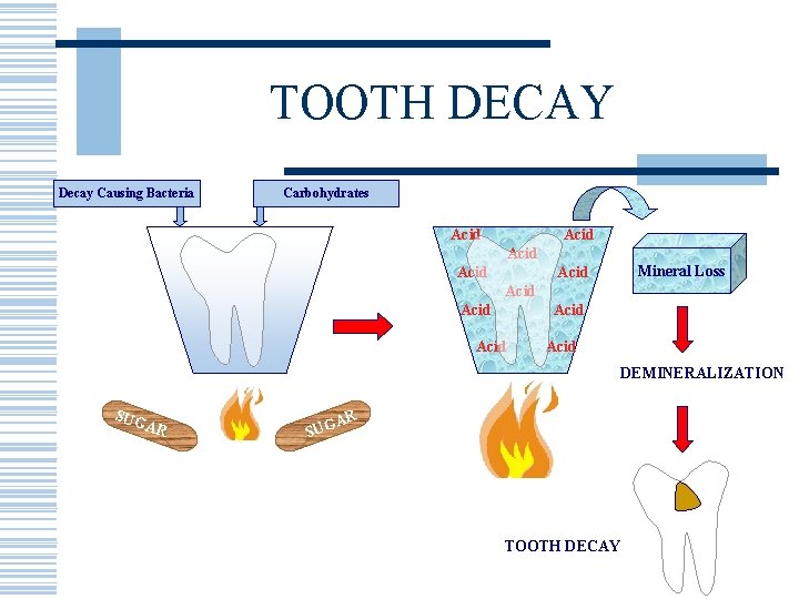TOOTH DECAY Decay Causing Bacteria Carbohydrates Acid Mineral Loss Acid Acid DEMINERALIZATION SUG AR