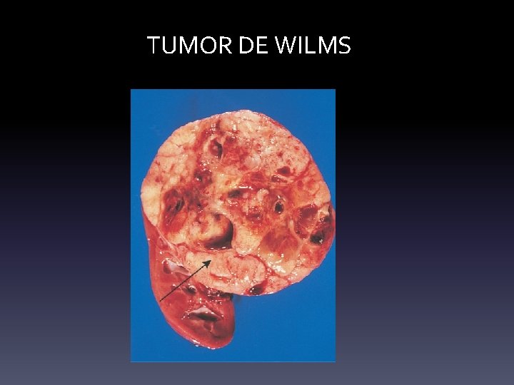 TUMOR DE WILMS TUMOR DE WILMS