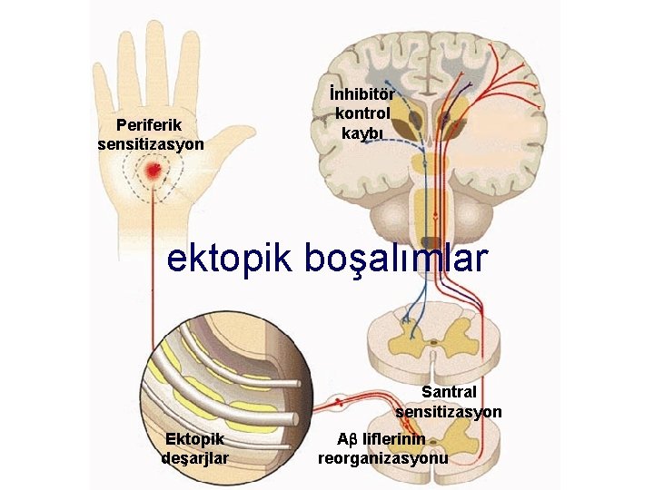 Periferik sensitizasyon İnhibitör kontrol kaybı ektopik boşalımlar Santral sensitizasyon Ektopik deşarjlar A liflerinin reorganizasyonu