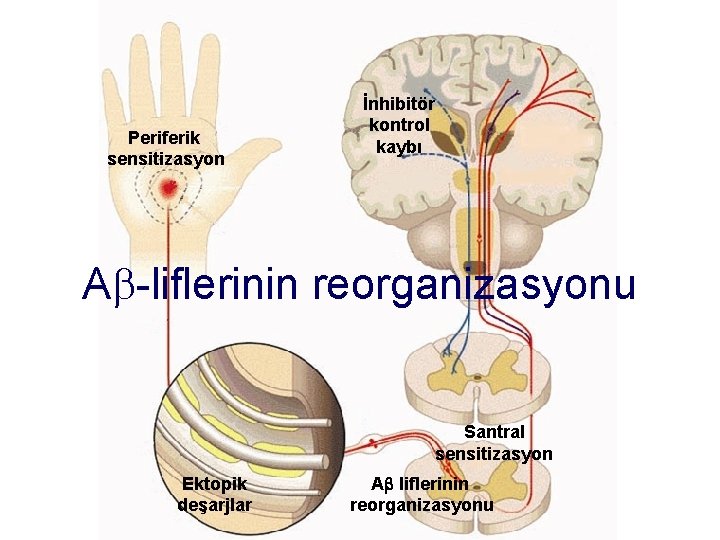 Periferik sensitizasyon İnhibitör kontrol kaybı A -liflerinin reorganizasyonu Santral sensitizasyon Ektopik deşarjlar A liflerinin