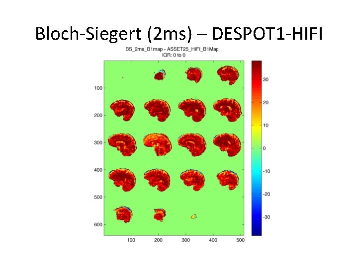Bloch-Siegert (2 ms) – DESPOT 1 -HIFI 