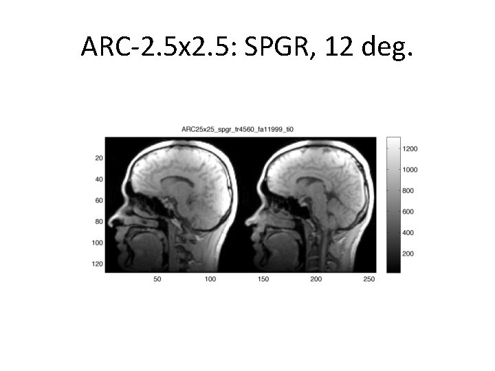 ARC-2. 5 x 2. 5: SPGR, 12 deg. 