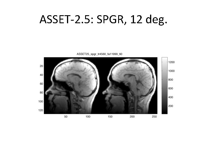 ASSET-2. 5: SPGR, 12 deg. 