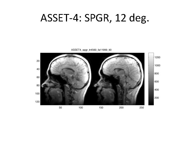 ASSET-4: SPGR, 12 deg. 