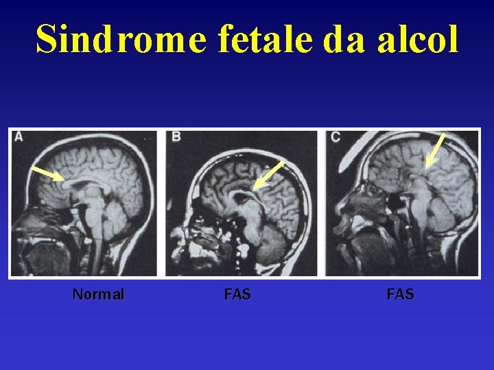 Sindrome fetale da alcol Normal FAS 