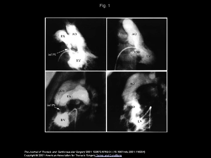 Fig. 1 The Journal of Thoracic and Cardiovascular Surgery 2001 122872 -878 DOI: (10.