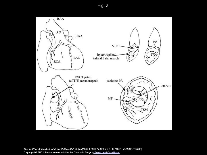 Fig. 2 The Journal of Thoracic and Cardiovascular Surgery 2001 122872 -878 DOI: (10.