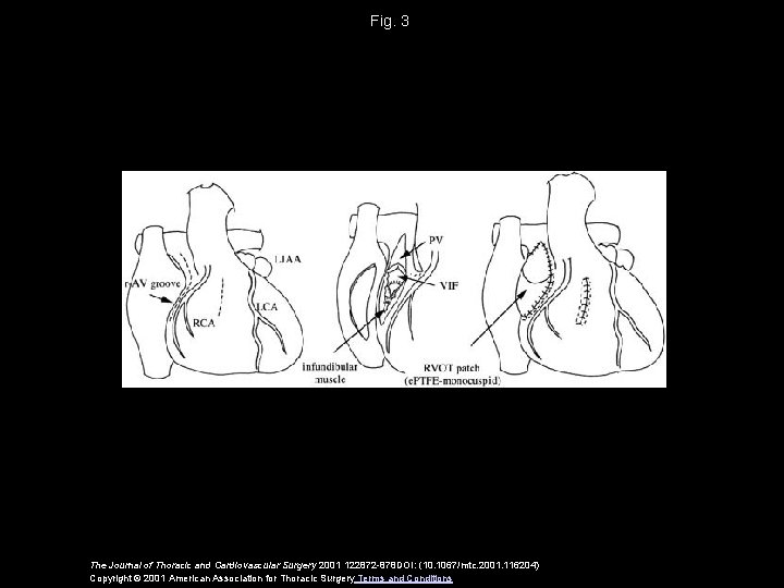 Fig. 3 The Journal of Thoracic and Cardiovascular Surgery 2001 122872 -878 DOI: (10.