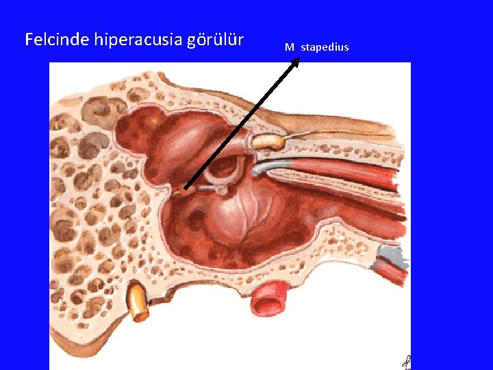 Felcinde hiperacusia görülür M. stapedius 