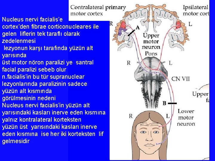 Nucleus nervi facialis’e cortex’den fibrae corticonucleares ile gelen liflerin tek taraflı olarak zedelenmesi lezyonun Nucleus nervi facialis’e cortex’den fibrae corticonucleares ile gelen liflerin tek taraflı olarak zedelenmesi lezyonun