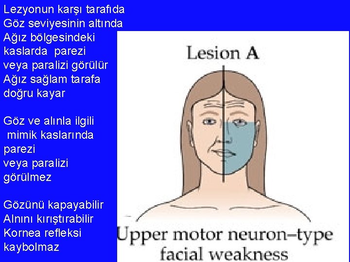 Lezyonun karşı tarafıda Göz seviyesinin altında Ağız bölgesindeki kaslarda parezi veya paralizi görülür Ağız