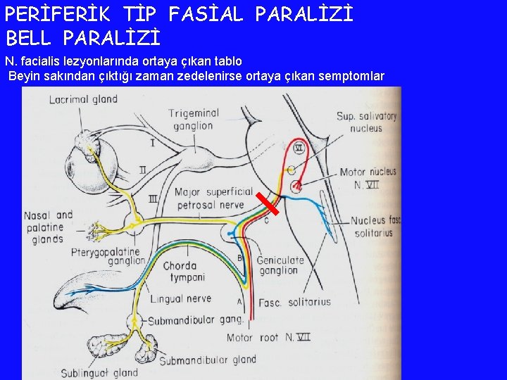 PERİFERİK TİP FASİAL PARALİZİ BELL PARALİZİ N. facialis lezyonlarında ortaya çıkan tablo Beyin sakından