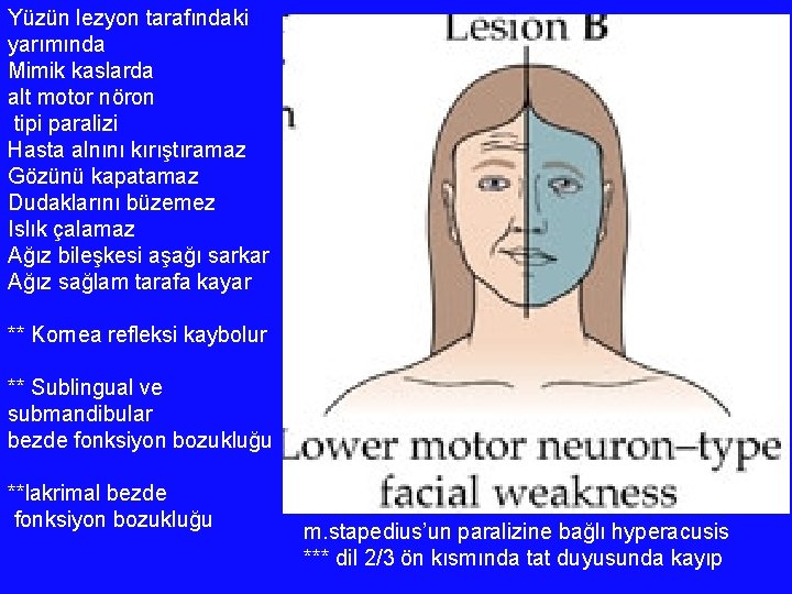 Yüzün lezyon tarafındaki yarımında Mimik kaslarda alt motor nöron tipi paralizi Hasta alnını kırıştıramaz