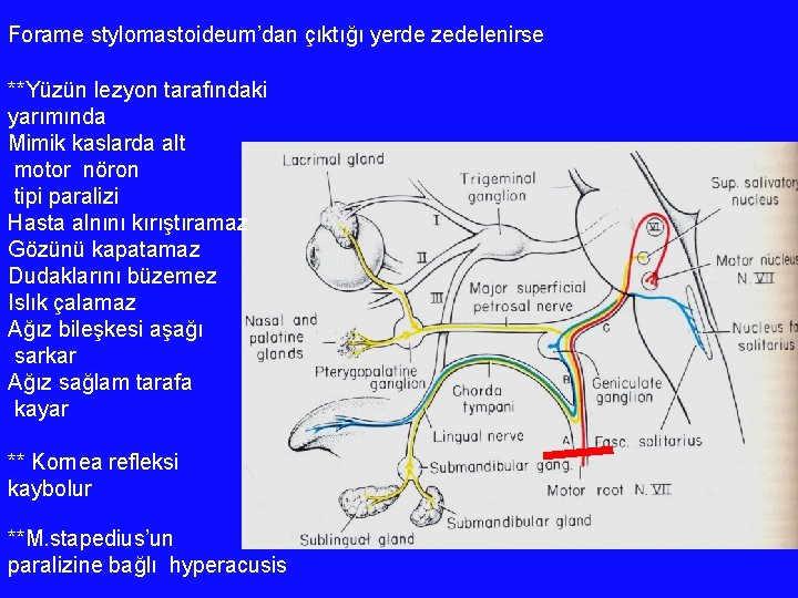 Forame stylomastoideum’dan çıktığı yerde zedelenirse **Yüzün lezyon tarafındaki yarımında Mimik kaslarda alt motor nöron Forame stylomastoideum’dan çıktığı yerde zedelenirse **Yüzün lezyon tarafındaki yarımında Mimik kaslarda alt motor nöron