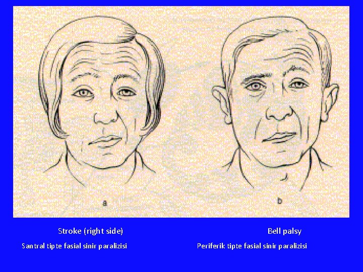 Stroke (right side) Santral tipte fasial sinir paralizisi Bell palsy Periferik tipte fasial sinir Stroke (right side) Santral tipte fasial sinir paralizisi Bell palsy Periferik tipte fasial sinir
