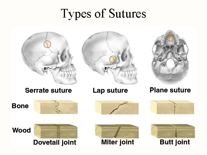 Types of Sutures 