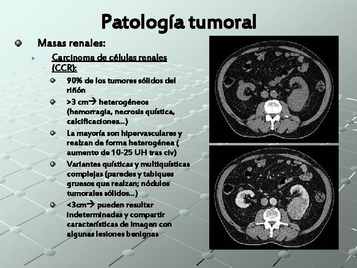 Patología tumoral Masas renales: Ø Carcinoma de células renales (CCR): 90% de los tumores