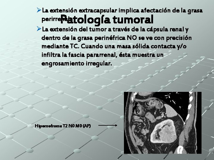 ØLa extensión extracapsular implica afectación de la grasa perirrenal. ØLa extensión del tumor a