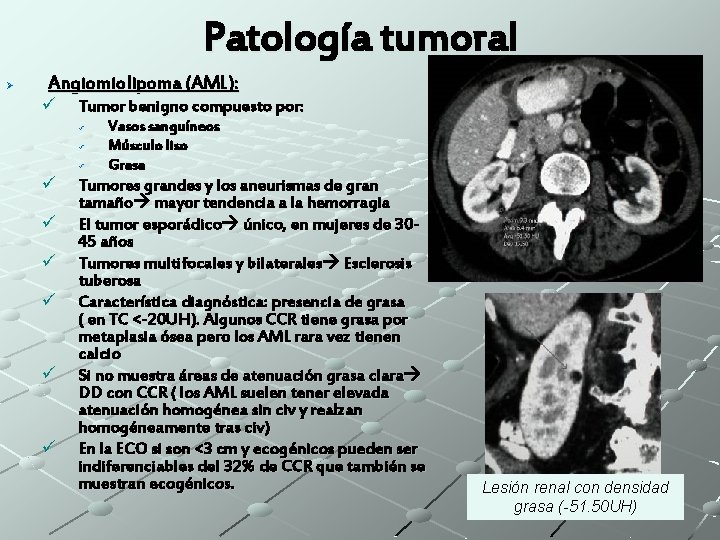 Patología tumoral Ø Angiomiolipoma (AML): ü Tumor benigno compuesto por: ü ü ü ü