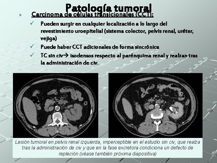 Ø Patología tumoral Carcinoma de células transicionales (CCT): ü Pueden surgir en cualquier localización