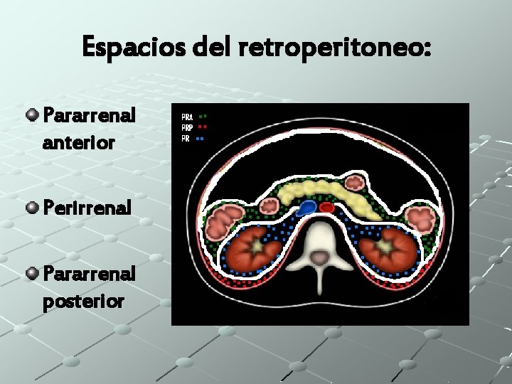 Espacios del retroperitoneo: Pararrenal anterior Perirrenal Pararrenal posterior 