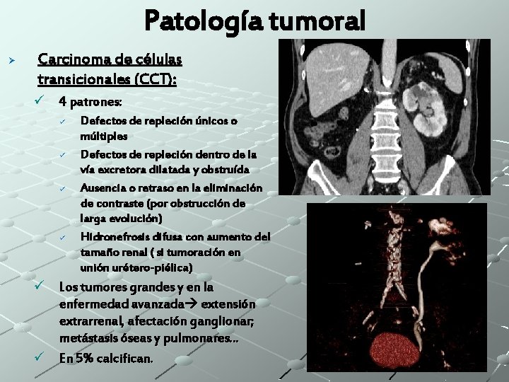 Patología tumoral Ø Carcinoma de células transicionales (CCT): ü 4 patrones: ü ü Defectos