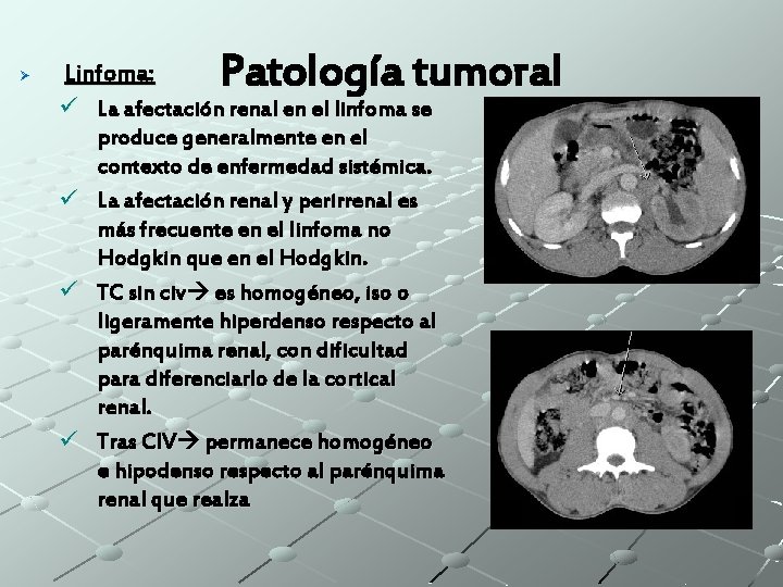 Ø Linfoma: Patología tumoral ü La afectación renal en el linfoma se produce generalmente